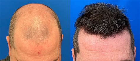 albuquerque hair transplant|Hair Transplant Surgeon, Austin, Houston, San Antonio & Dallas, Texas.